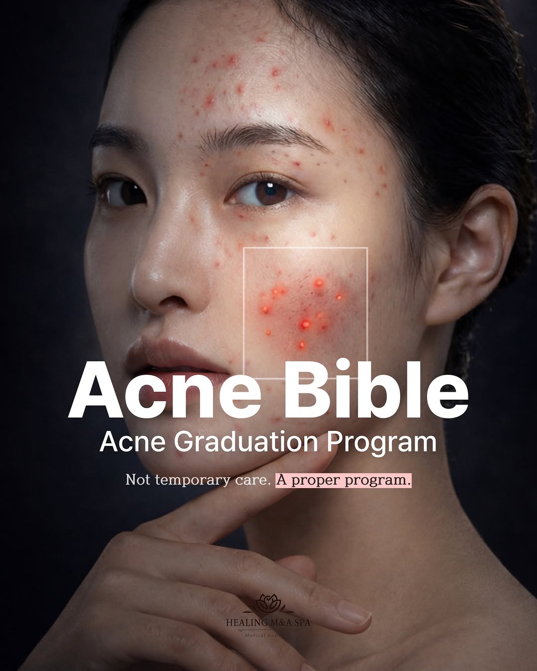 Acne Bible Program — a proper skin treatment program at Healing M&A Spa